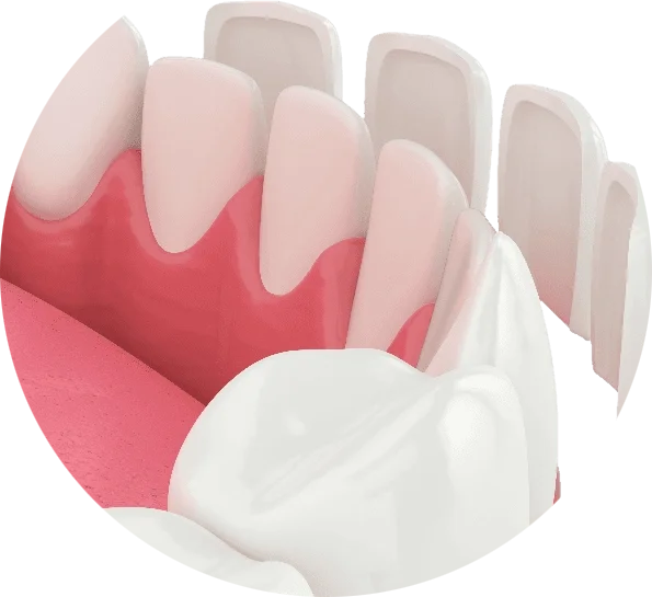 Баннер Установить виниры Баннер Установить виниры